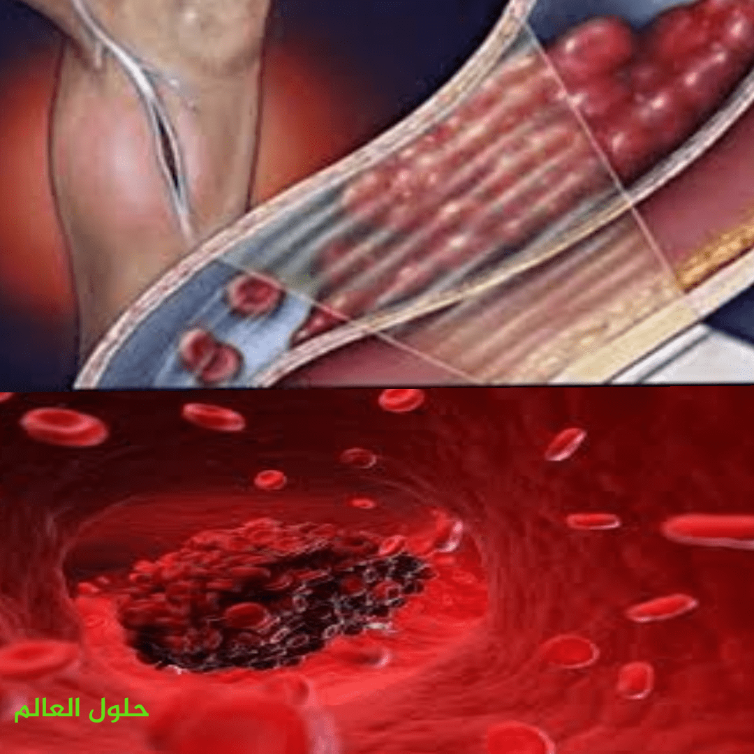 تعريف الجلطة Blood clot