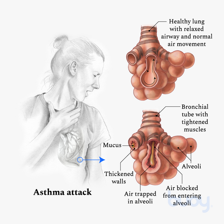 أعراض الربو وأسبابه asthma symptoms