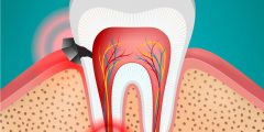 علاج ألم الأسنان TOOTHACHE