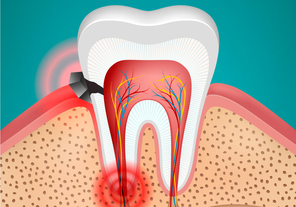 علاج ألم الأسنان toothache