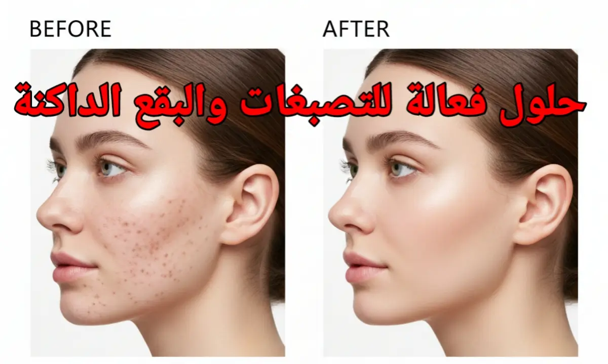 التصبغات والبقع الداكنة | الأسباب، الأنواع، وأفضل طرق العلاج